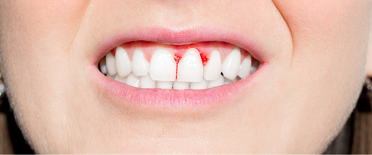 bleeding-gums-cover