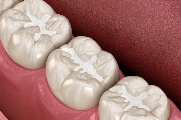 σιλαντ sealant paidiatros odontiatros σιλαντ sealant paidiatros odontiatros
