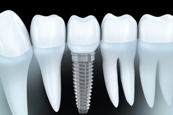 Dental-implant-8976786