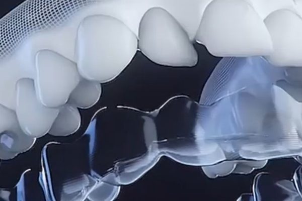 Invisalign – Ορθοδοντική – Σιδεράκια – Τιμη – siderakia Invisalign - Ορθοδοντική - Σιδεράκια - Τιμη - siderakia