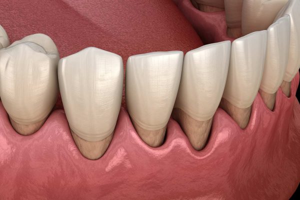 Periodontal-Disease περιοδοντίτιδα περιοδοντολόγος Periodontal-Disease περιοδοντίτιδα περιοδοντολόγος