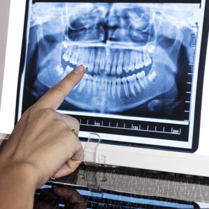 dental-x-rays dental-x-rays