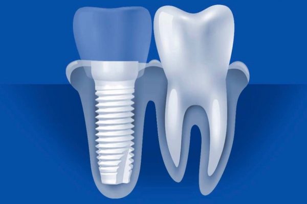 implant – emfyteymata – εμφυτεύματα – Καλαματα implant - emfyteymata - εμφυτεύματα - Καλαματα