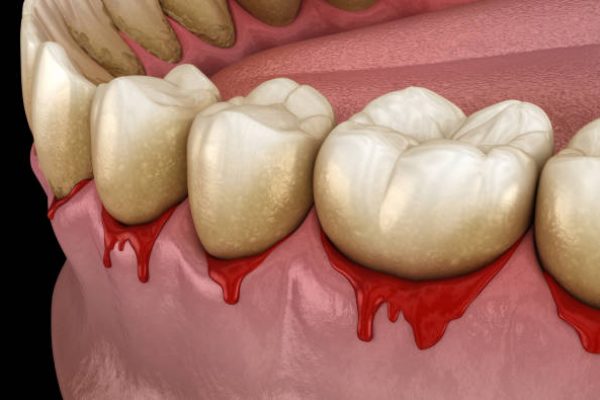 oylitida aima matomena dontia ματωμένα δόντια Bleeding gums or Periodontal - pathological inflammatory condition of the gum and bone support. Dental 3D illustration